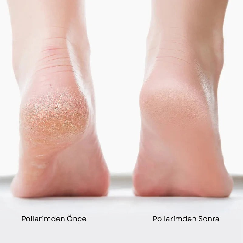 Pollarim™ SoftHeel